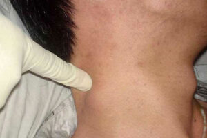 лимфосаркома