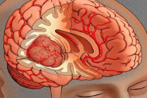 эпендимома