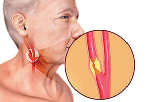хемодектома