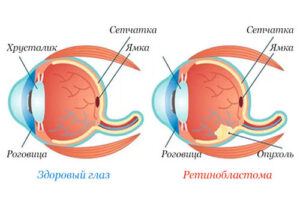 ретинобластома