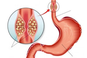 рак пищевода