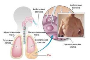 рак плевры