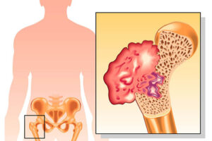 остеохондрома