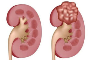 нефробластома 