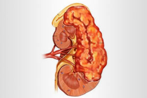 альдостерома