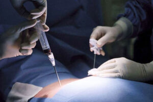 лечение рака лимфоузлов