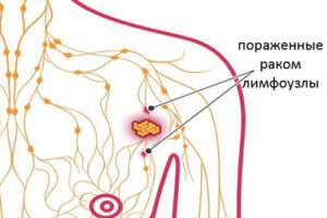 рак лимфоузлов