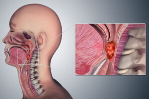рак носоглотки