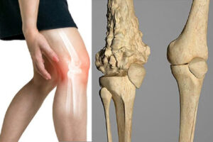 остеосаркома