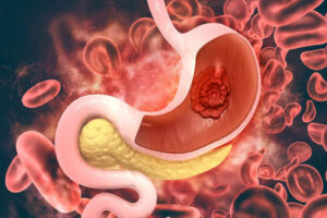 рак желудка