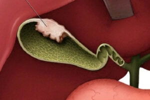 рак желчного пузыря