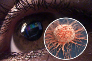 рак глаза
