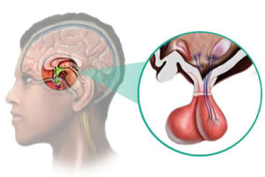 аденома гипофиза