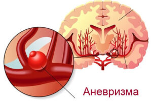 аневризма головного мозга