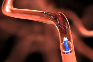 лечение аневризмы головного мозга