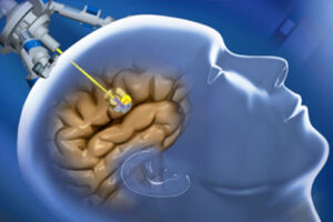 диагностика глиомы