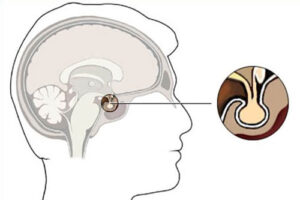 киста гипофиза