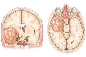 менингиома