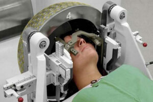 лечение менингиомы