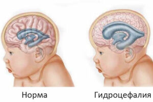 Лечение гидроцефалии в США