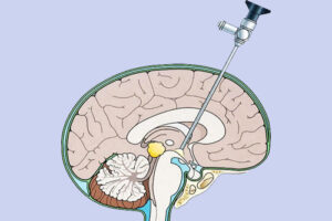 лечение гидроцефалии
