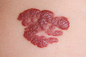 гемангиома