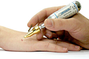 лечение ангиомы