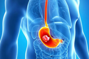 рак желудка