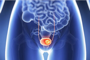 рак мочевого пузыря 