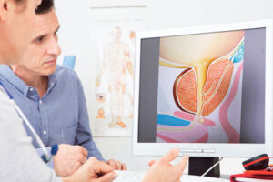 лечение рака простаты