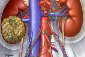 рак почки