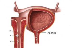 рак уретры
