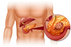 рак поджелудочной железы