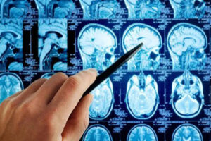 глиобластома