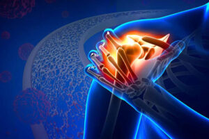 хондросаркома