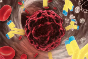 лечение хондросаркомы