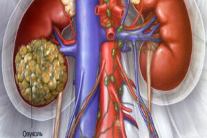 карцинома почек