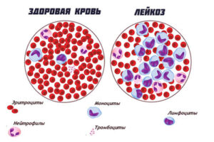 миелолейкоз
