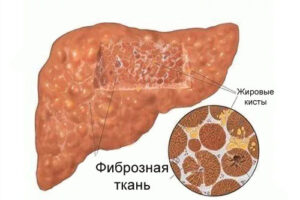 фиброз печени