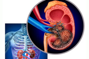 карцинома почек