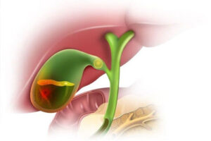 холецистит