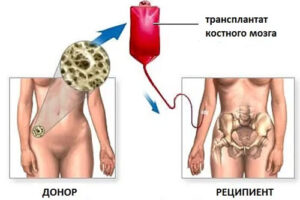 лечение рака костного мозга