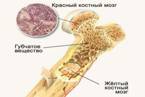 рак костного мозга