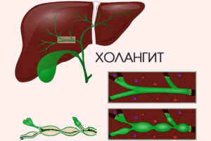 холангит