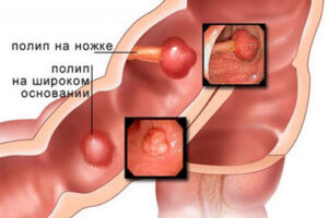 полипоз кишечника