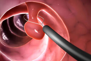 лечение полипоза кишечника