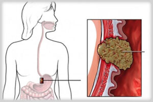 аденокарцинома желудка