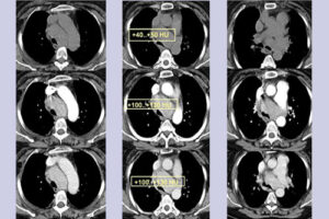 киста средостения