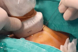 лечение кисты средостения