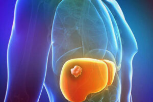 гемангиома печени